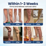 Deep Vein Repair Microneedle Patch