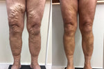 Deep Vein Repair Microneedle Patch