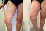 Deep Vein Repair Microneedle Patch
