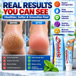 Diabetic Foot Cream for Cracked Heels
